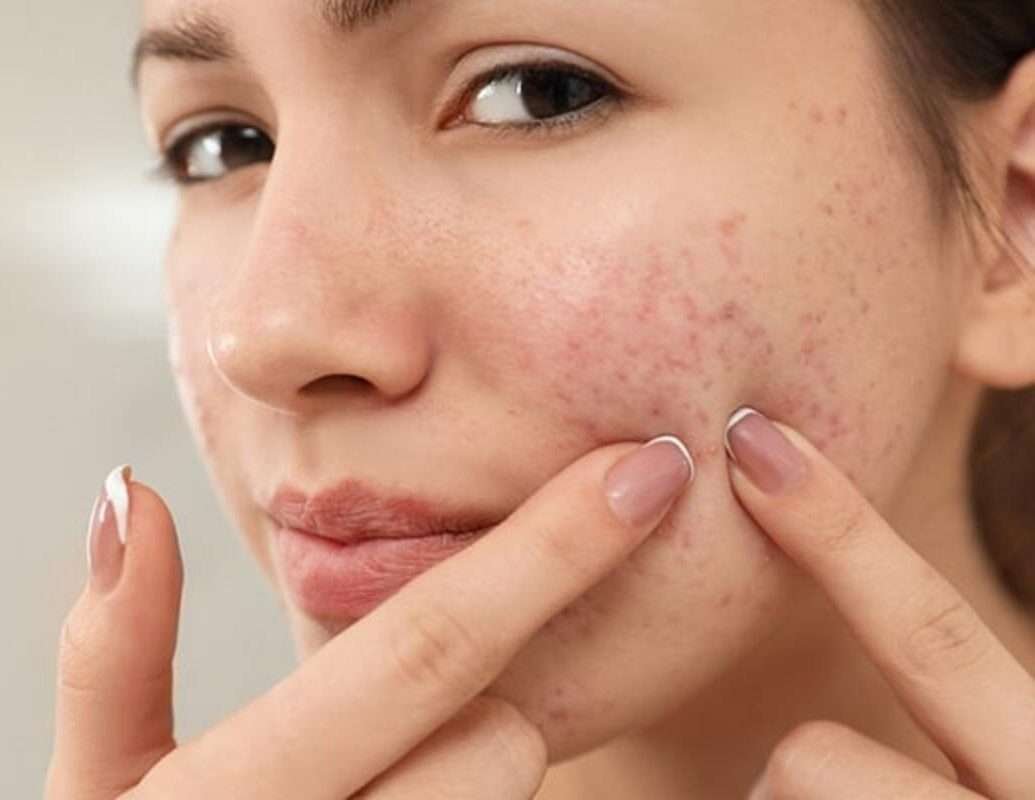 Acne Treatment